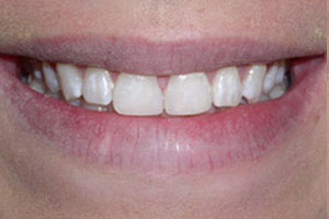 After-Dental Bonding Gap