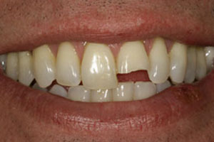 Before-Dental Bonding