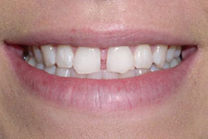 Before-Dental Bonding Gap