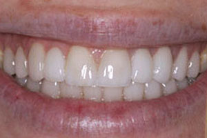 After-Crown Before and After photos Del Sur Dentistry 92127