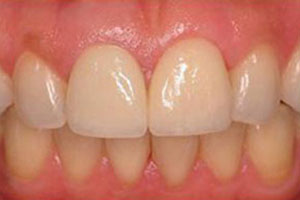 After-Dental Crown Before and After