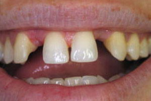 Before-Crown Before and After photos Del Sur Dentistry 92127