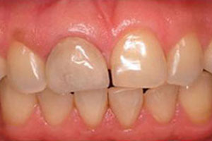 Before-Dental Crown Before and After