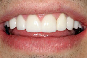 After-Dental Crown Before and After Photo at Del Sur Dentistry San Diego 92127