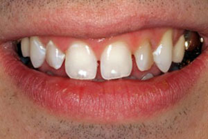 Before-Dental Crown Before and After Photo at Del Sur Dentistry San Diego 92127
