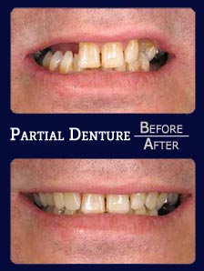 Denture before and after results
