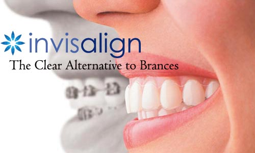 Invisalign Gallery Before and After Photos