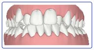 Invisalign Teeth Crowding