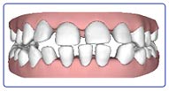 Invisalign-case-2