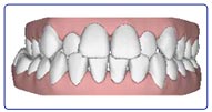 Invisalign-case-3