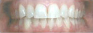 After-Invisalign Case 4