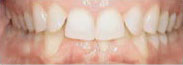 Before-Invisalign Case 4