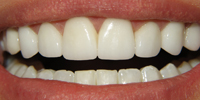 After-Veneer Before and After