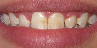 Before-Veneer Before and After