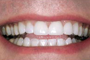After-Lumineer Veneer Before and After