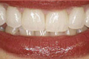 After-Veneer Before and After Photo