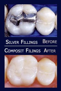 White Fillings before and after results