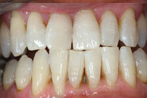 After-Zoom Teeth Whitening Before and After