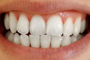 After-Zoom teeth whitening Del Sur Dentistry San Diego 92127