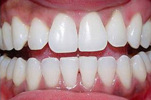 After-Zoom teeth whitening Del Sur Dentistry San DIego 92127