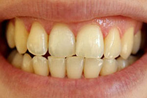 Before-Zoom teeth whitening Del Sur Dentistry San Diego 92127