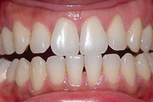 Before-Zoom teeth whitening Del Sur Dentistry San DIego 92127