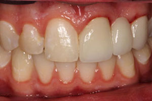 After-Dental Bridge