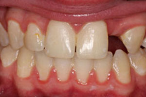 Before-Dental Bridge