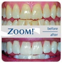 Zoom teeth whitening before and after