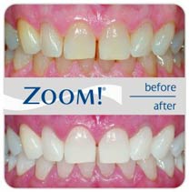 Zoom teeth whitening before and after