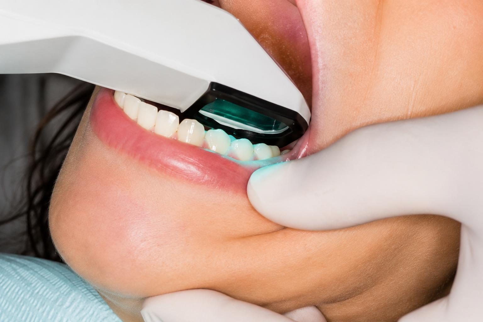 Patient receiving an Invisalign iTero digital scan at Del Sur Dentistry